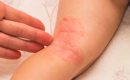Istock image of crook of child's knee with eczema all over it